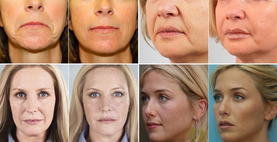 фотографије жена пре и после подмлађивања коже лица